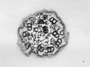 F,7y. | immotile cilia syndrome - nasal mucosa